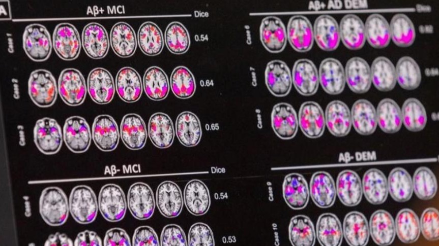 数十万元阿尔茨海默病疗法纳入首版商保创新药目录，离进医保还远吗  第1张